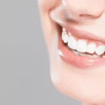 Can You Whiten Teeth After Icon Treatment