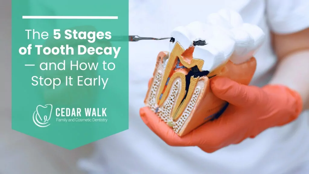5 Stages of Tooth Decay