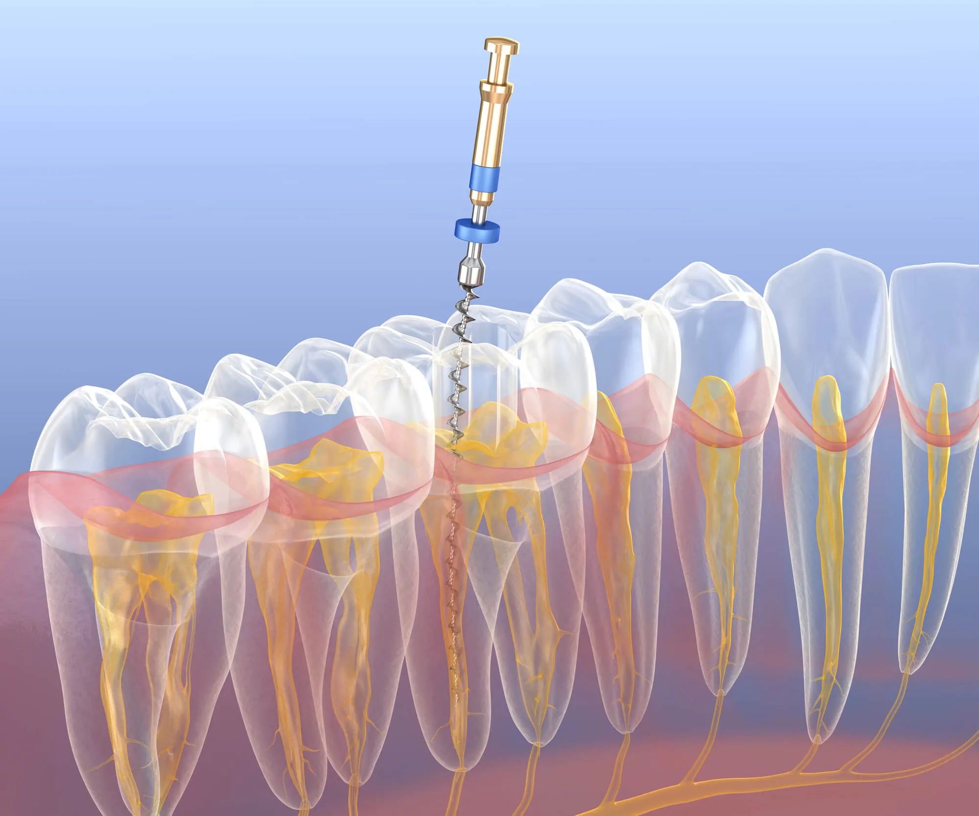 dentist-28277-shows-3D-illustration-of-root-canal-treatment