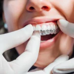 patient about to wear Invisalign charlotte