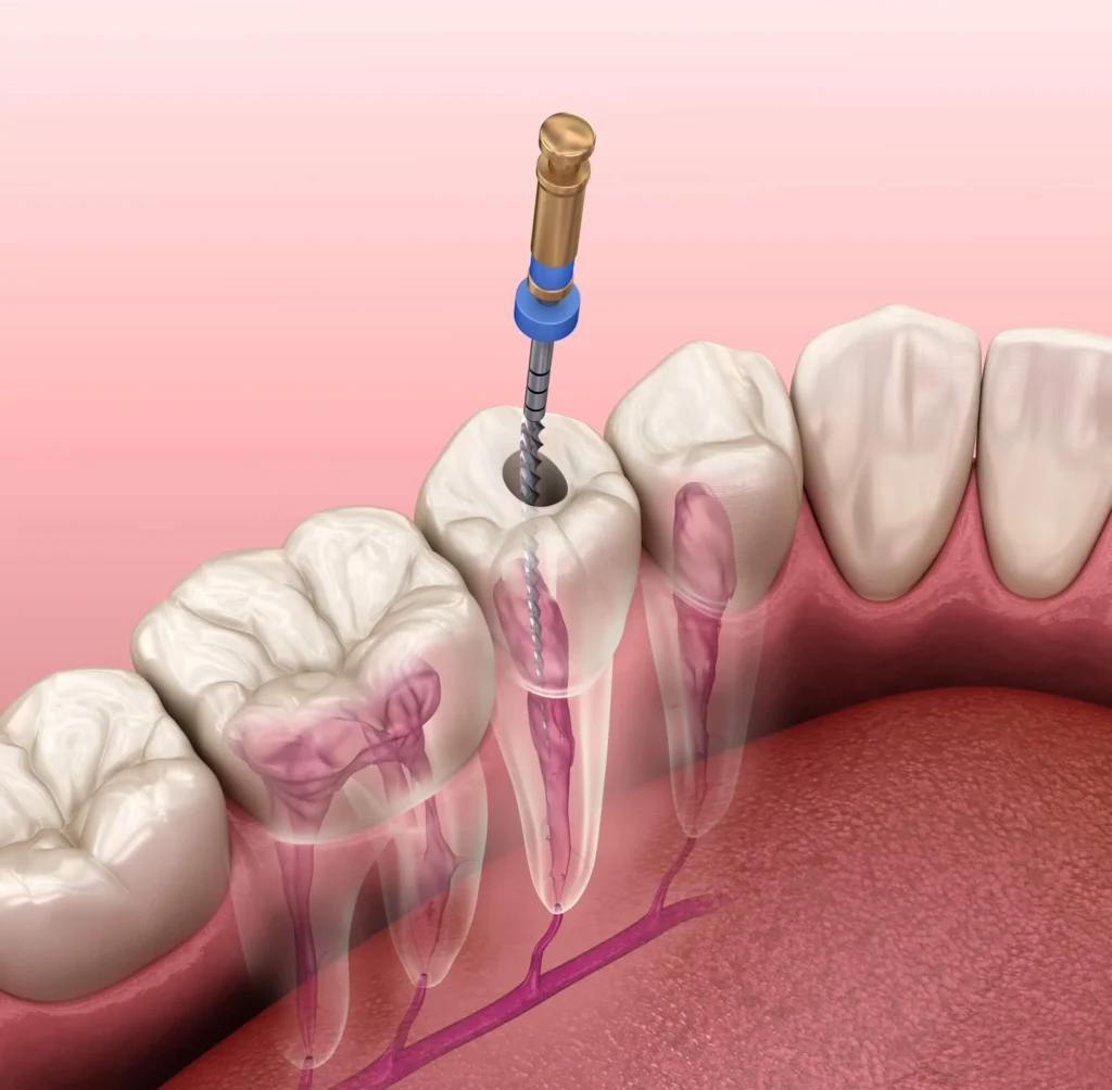 root canal charlotte