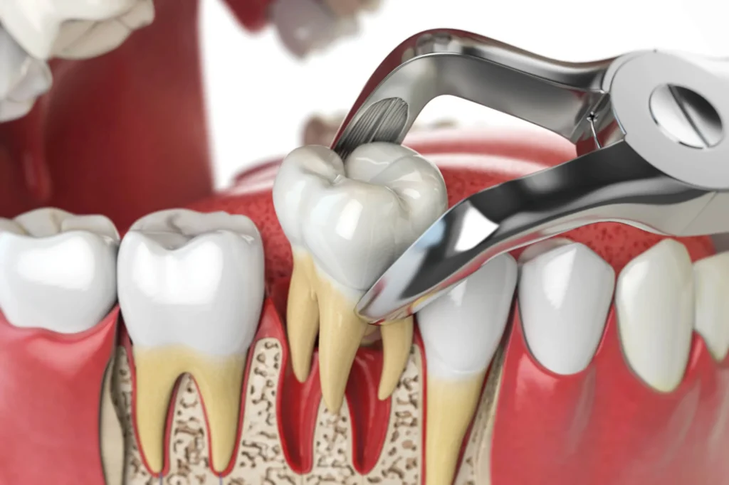 Dentist South Charlotte extracting tooth illustration