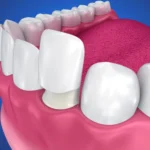 veneers charlotte