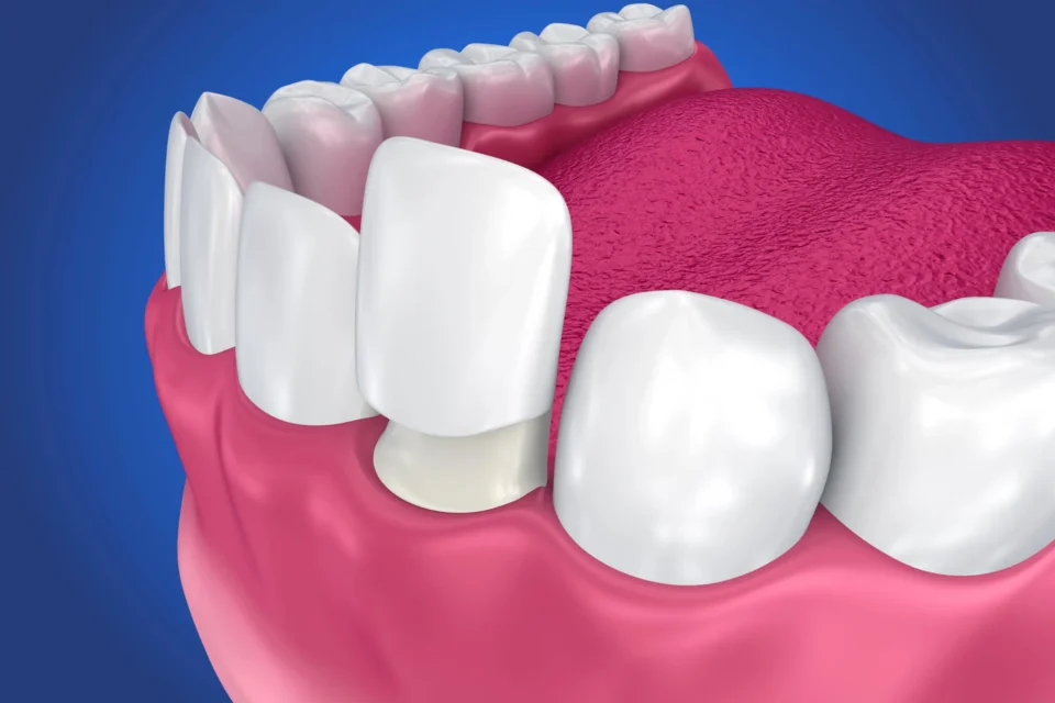 veneers charlotte