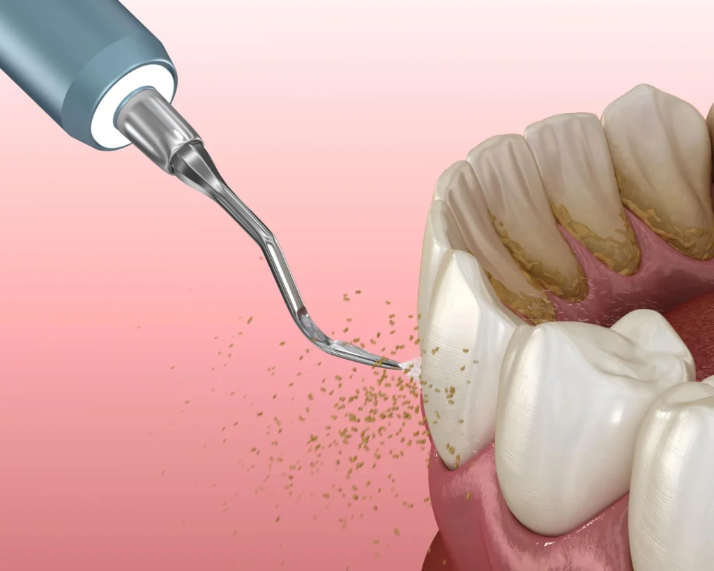 illustration-of-dental-cleaning-charlotte