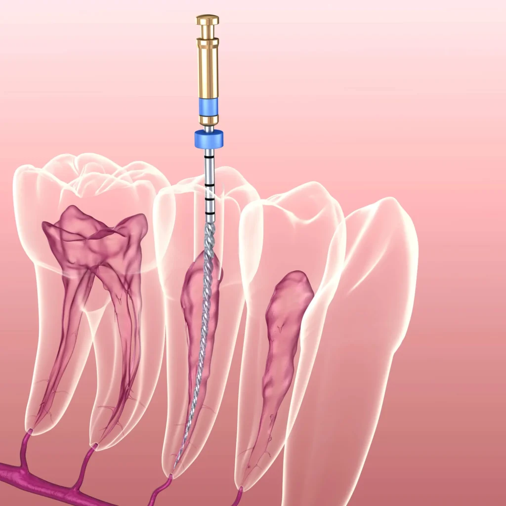 root-canal-charlotte-illustration